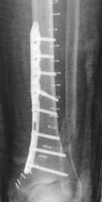 Tibia, Shaft:  Synthes Distal Tibial Plate (Implant 231)